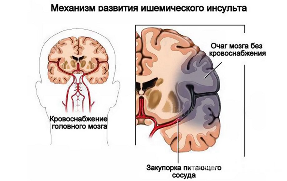 Признаки ишемического инсульта