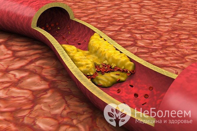 Высокий уровень холестерина – один из факторов риска ишемического инсульта