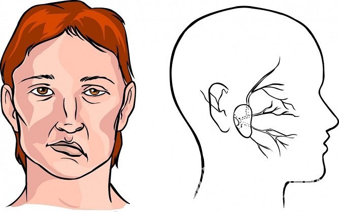 Один из симптомов ишемического инсульта – парезы и параличи мускулатуры лица