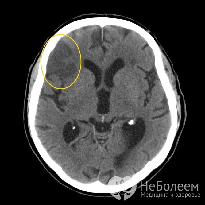 Ишемический инсульт на КТ