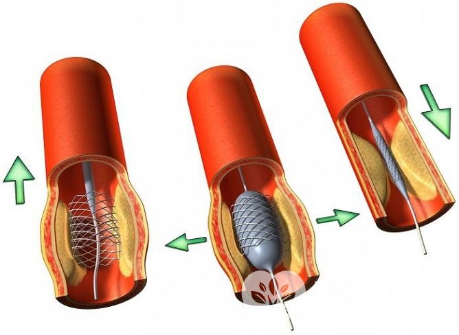 Коронарное стентирование – хирургический метод лечения тяжелой ишемии сердца