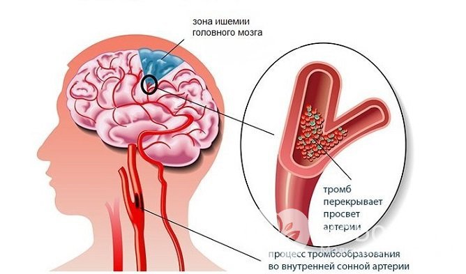 Ишемия головного мозга, развившаяся в результате тромбообразования