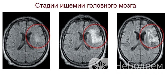 Стадии ишемии головного мозга
