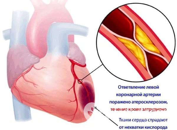 Ишемия сердечной мышцы - причина развития стенокардии