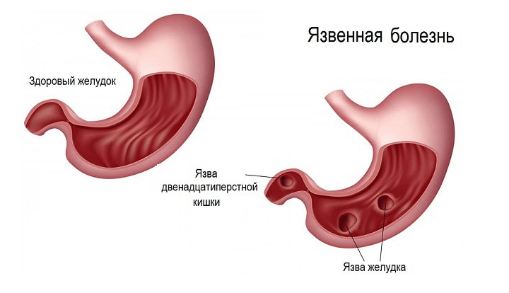 Признаки язвенной болезни двенадцатиперстной кишки