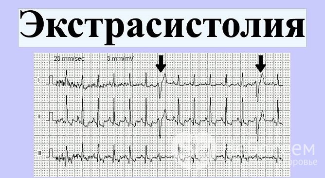 Экстрасистолия: причины аритмии и способы лечения