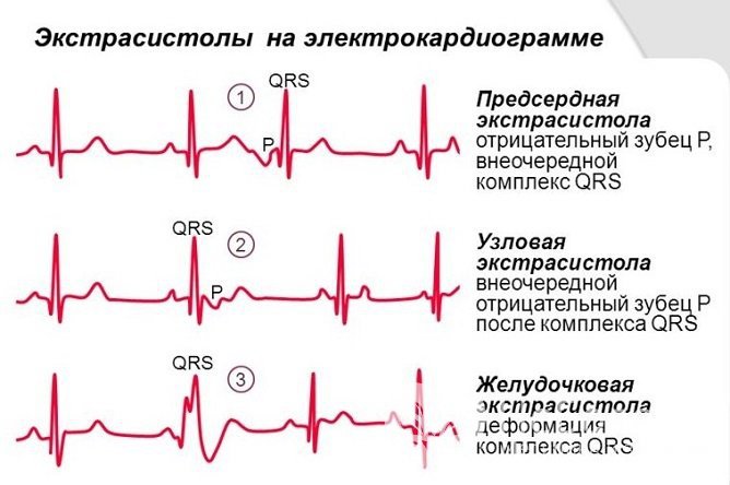 Классификация экстрасистолии по локализации генератора импульсов