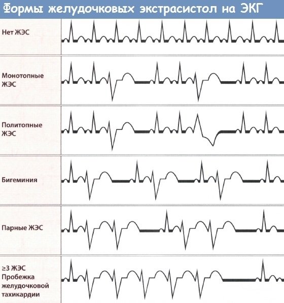 Классификация желудочковой экстрасистолии