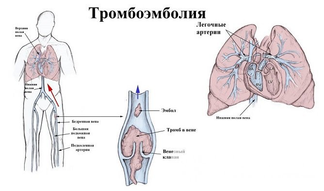 Тромбоэмболия легочной артерии