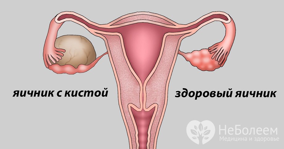 Признаки эндометриоидной кисты яичника