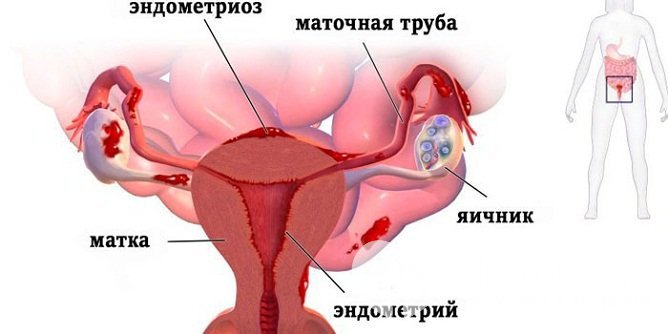 В большинстве случаев к развитию эндометриоидной кисты яичника приводит ретроградная менструация