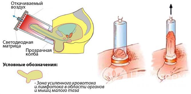 Вакуум-констрикторная терапия – один из эффективных методов лечения эректильной дисфункции