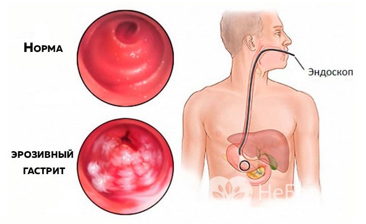 Признаки эрозивного гастрита