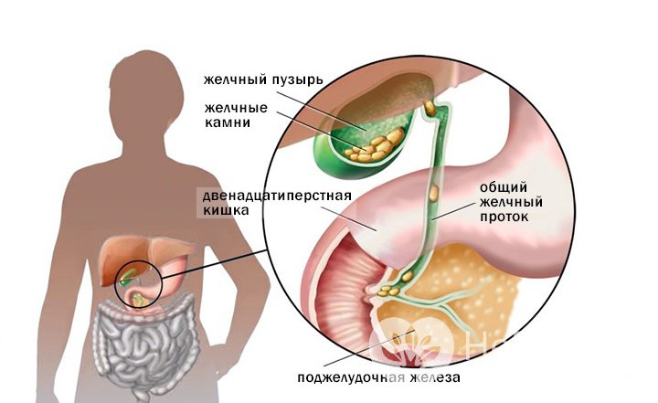 Признаки калькулезного холецистита