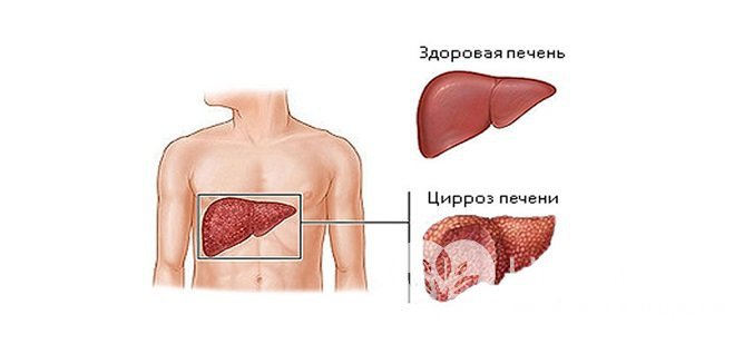 Цирроз печени может приводить к развитию калькулезного холецистита