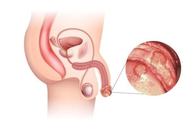 Кандидозный баланит – одна из форм кандидоза у мужчин