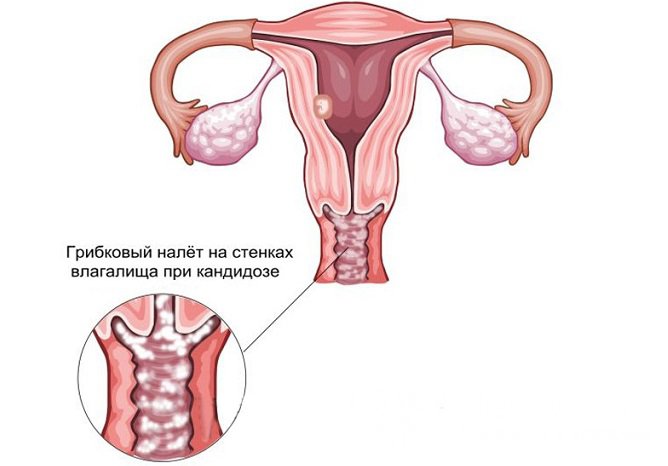 При кандидозном вульвовагините поражаются слизистые оболочки влагалища и вульвы