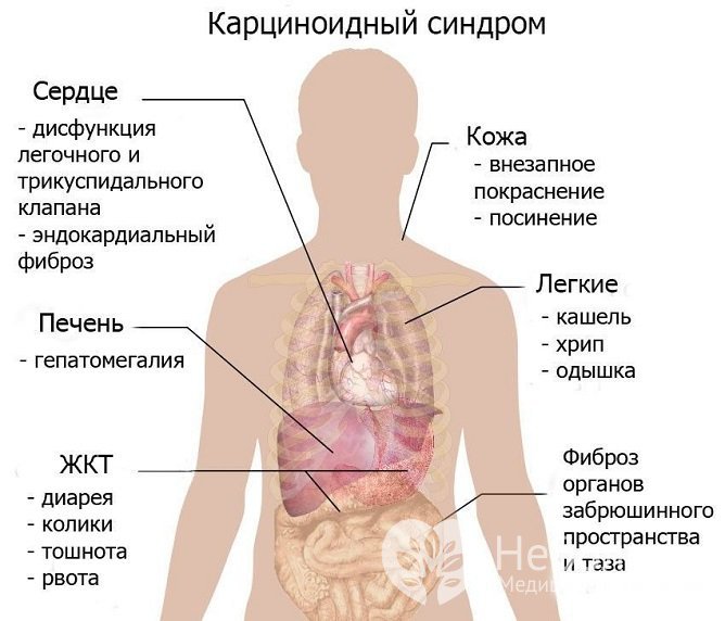 Симптомы карциноидного синдрома