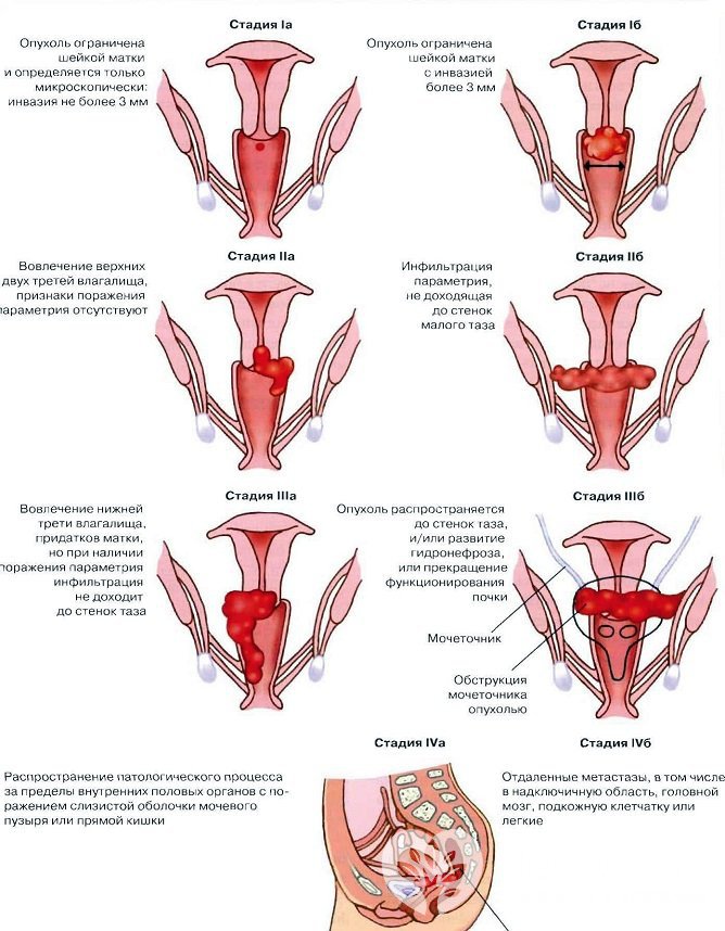 Степени карциномы на примере рака шейки матки