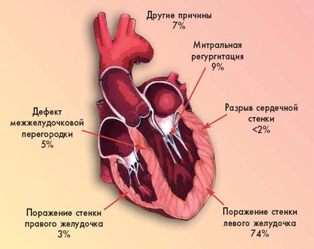 Основные причины кардиогенного шока