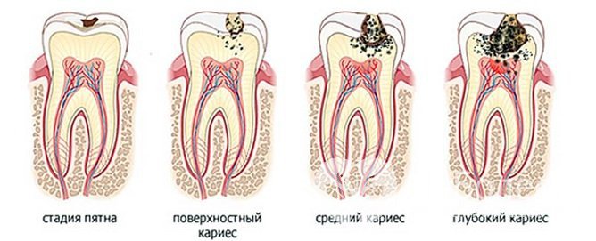 4 стадии кариеса у детей