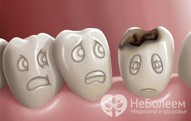 На средней стадии кариеса на видимом участке зуба появляется дупло (пятно с темно окрашенным дном и скошенными краями
