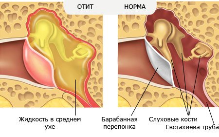 Катаральный отит характеризуется скоплением воспалительного экссудата в барабанной полости