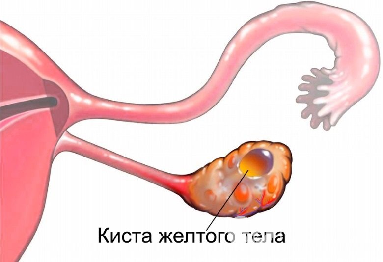 Признаки кисты желтого тела яичника