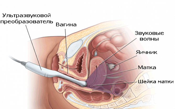 При подозрении на кисту желтого тела яичника выполняется трансвагинальное УЗИ