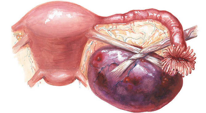 Опасное осложнение кисты желтого тела яичника, перекрут ножки, может привести к летальному исходу