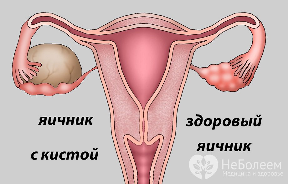 Признаки кисты яичника