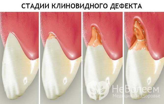 Стадии клиновидного дефекта