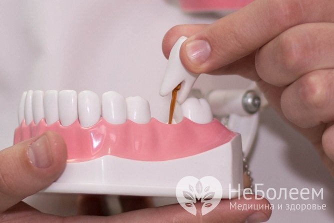 При глубоких клиновидных дефектах зубов применяется ортопедическое лечение