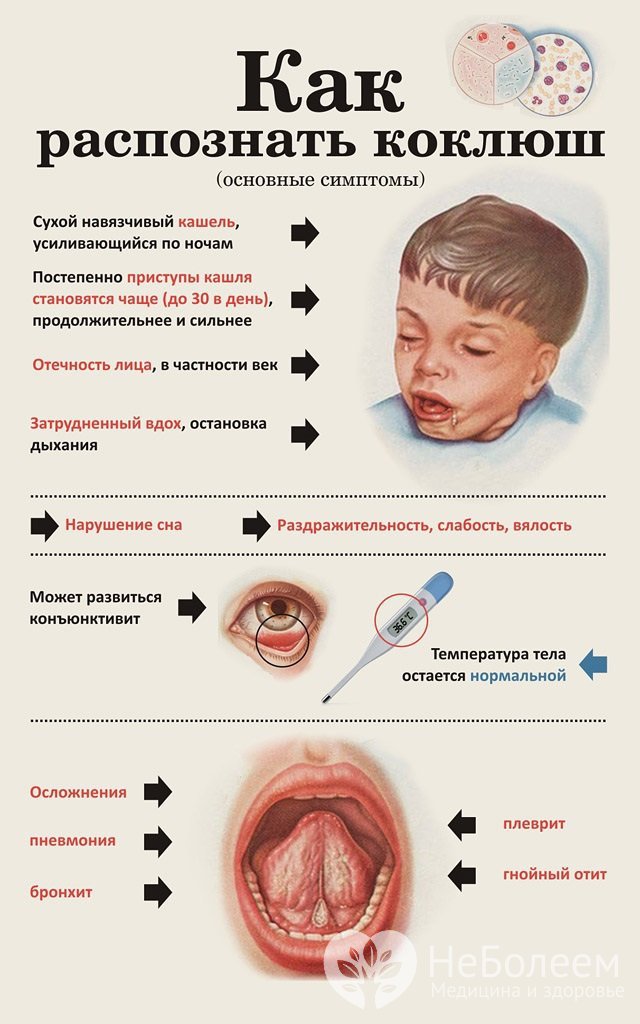 Симптомы коклюша у детей схожи с симптомами других заболеваний дыхательных путей