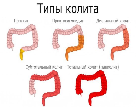 Типы колита в зависимости от локализации воспаления