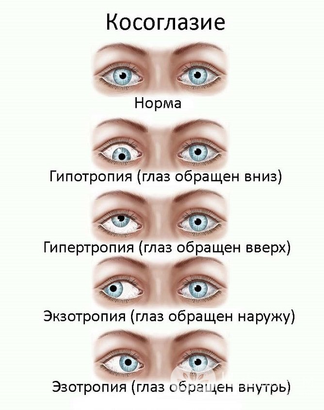 Косоглазие встречается у 2-3% детей и может принимать разные формы