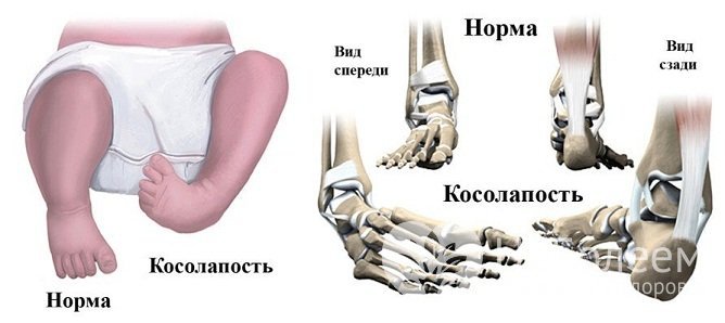 Косолапость у детей легко определяется визуально