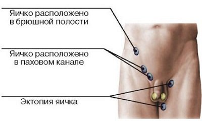 Крипторхизм - часто встречающаяся аномалия, неопущение яичка в мошонке