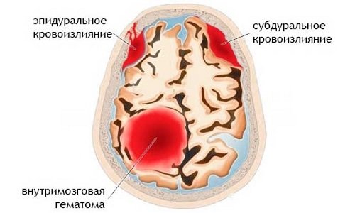 Существует три вида оболочечных кровоизлияний