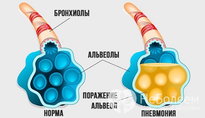 Крупозная пневмония характеризуется воспалительным уплотнением одного или нескольких сегментов легких