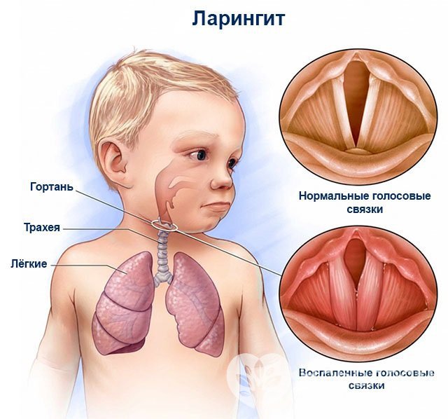 Ларингит у детей чаще развивается в холодное время года