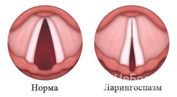 Ларингоспазм характеризуется внезапным смыканием гортани