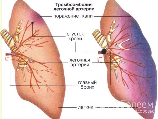 Что такое легочная эмболия?