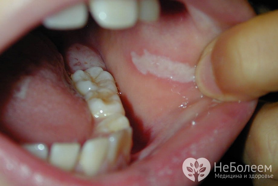 Симптомы лейкоплакии полости рта 