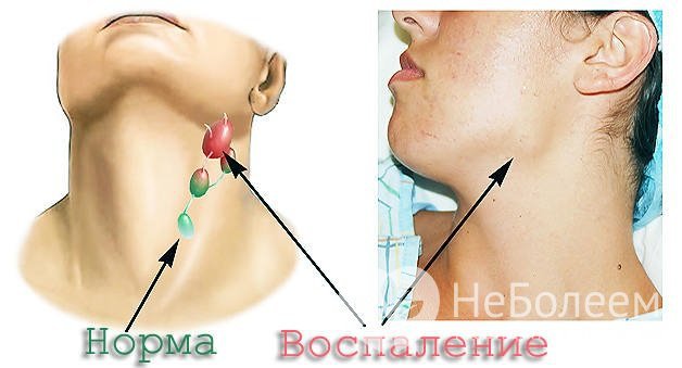 Диагностика лимфаденопатии направлена на выявление основного заболевания