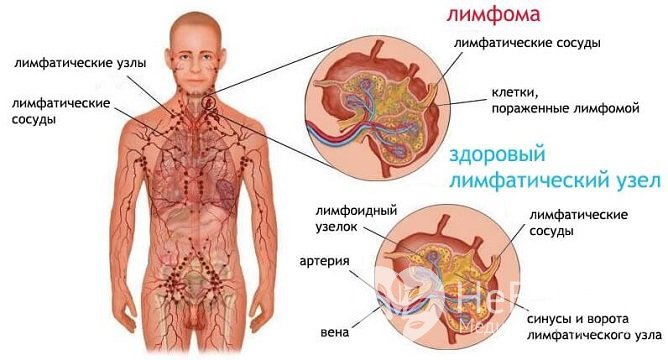 Лимфома Ходжкина - это рак лимфатических узлов, другое название – лимфогранулематоз