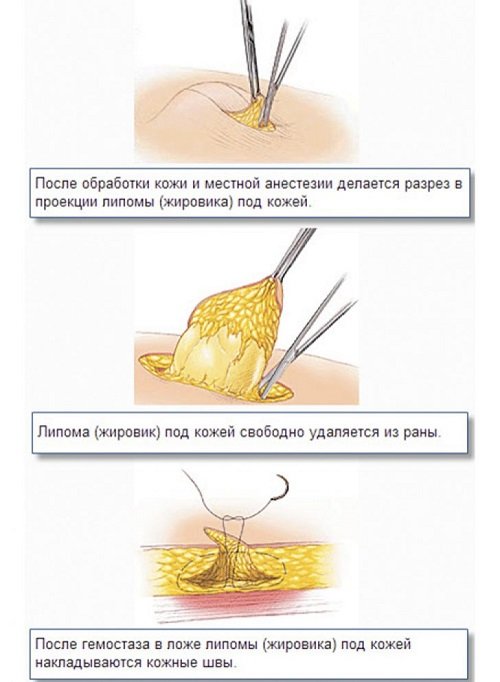 Хирургическое удаление лимпом - основной метод лечения липоматоза