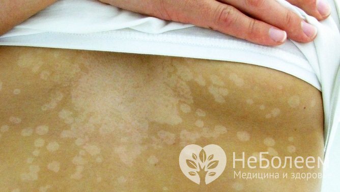 При отрубевидном лишае на пораженных участках кожи не появляется загар