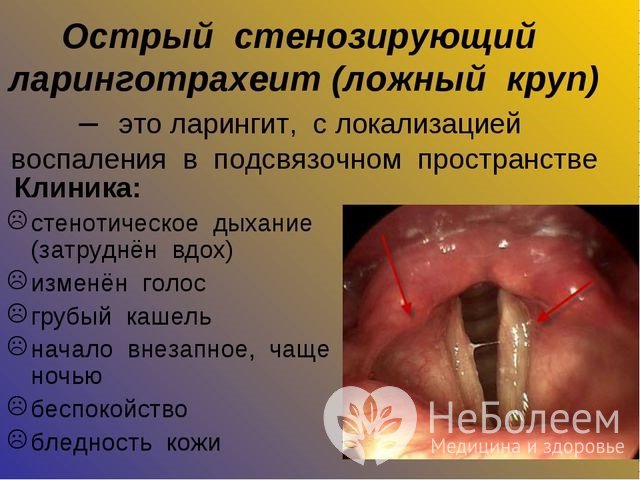 Ложный круп обычно развивается у детей первых трех лет жизни