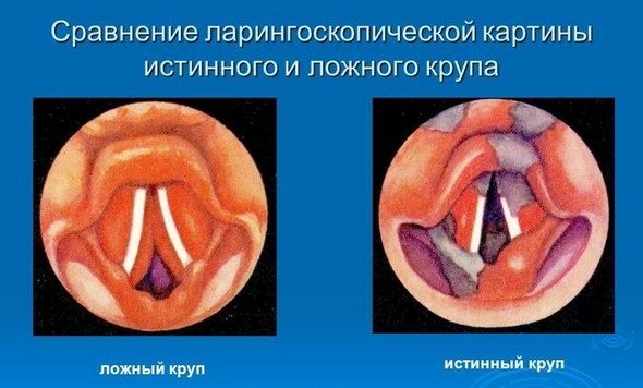 Истинный круп, в отличие от ложного крупа, развивается при дифтерии